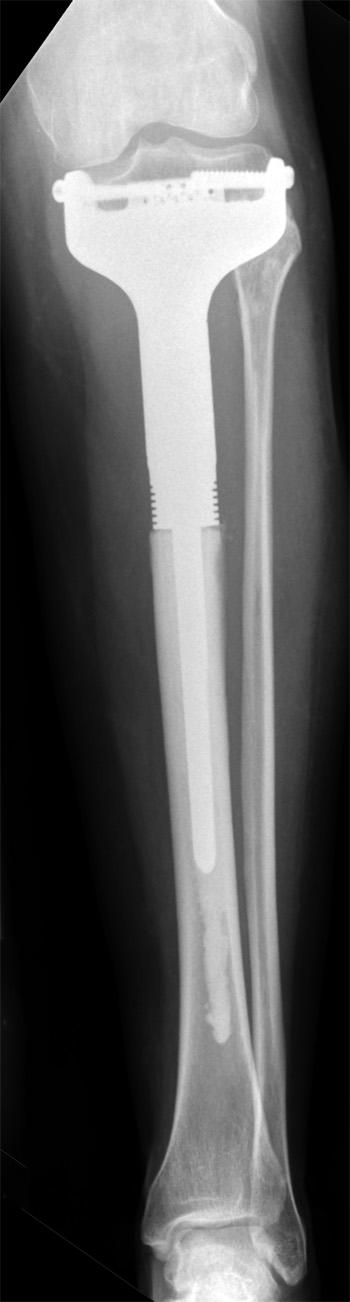 THE EARLY RESULTS OF JOINT-SPARING PROXIMAL TIBIAL REPLACEMENT FOR PRIMARY BONE TUMOURS 1375 Fig.