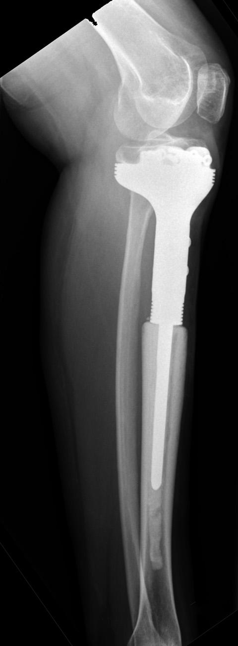 Note two x 10 mm blades on the component surface to further improve metaphyseal fixation. Fig. 2a Fig.