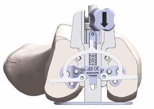 The external rotation can also be checked taking into account the alignment to the epicondylar axis, using the