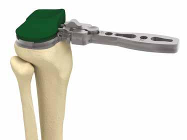 6. TRIAL REDUCTION All of the major bone cuts have now been made. The osteotomies described will render the knee stable in flexion and extension when the appropriate components are selected.