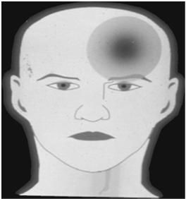 ICHD Criteria: Cluster Headache (3.1) A. Min of 5 attacks B. Lasting 15 mins to 3 hrs (180min) - untreated Severe or very severe Strictly unilateral Orbital, supraorbital or temporal B.