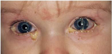 BACTERIAL CONJUNCTIVITIS Usually younger population (1-5yo) May be