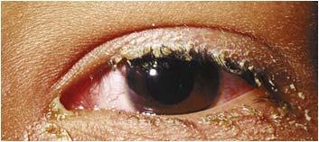 associated with NLDO Key findings: Diffuse redness to conjunctiva