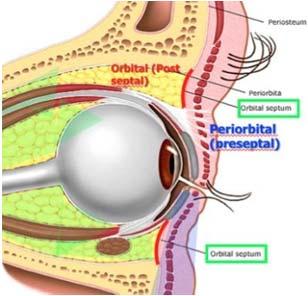 Irregular or fixed pupil (+APD) Increased pain even with treatment Proptosis