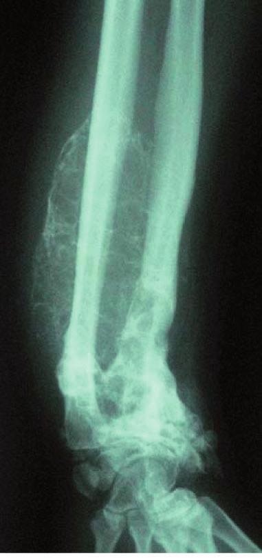 involves the ends of long bones (1). Despite its typical benign histologic features, multiple skeletal (2) and lung metastases were reported (3).