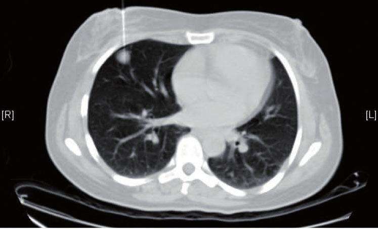 figure 2). CT of the lung reported multiple bilateral variable size pulmonary nodules ( five in the right and one in the left basal segments).
