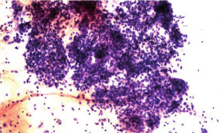 Cytology examination reported benign features and showed a mixture of multinucleated and mononucleated cells with similar oval nuclei with, fine to granular chromatin, small nucleoli and variable