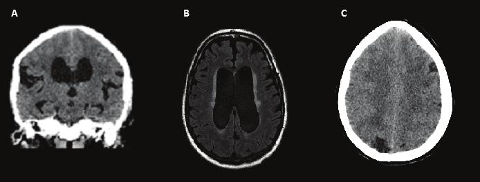 Idiopathic Normal Pressure Hydrocephalus: An Overview of Pathophysiology, Clinical Features, Diagnosis and Treatment http://dx.doi.org/10.5772/64198 535 Figure 2.