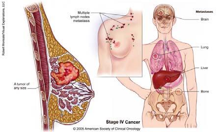 Metastasis Spreading of from one organ to another The many steps of