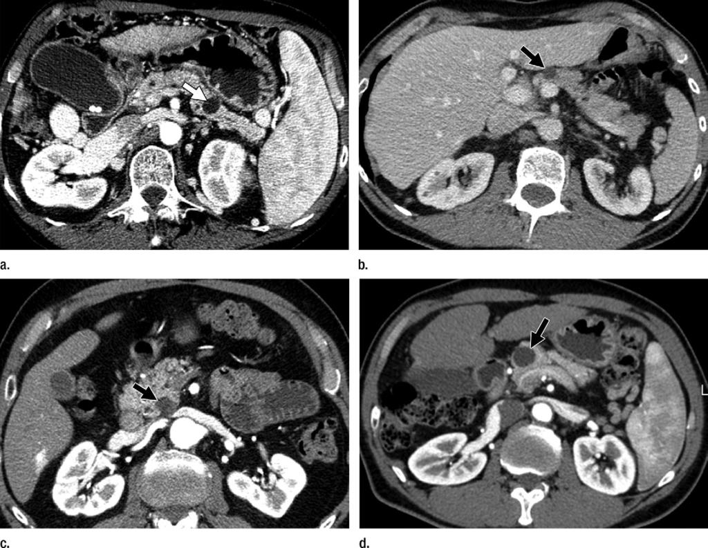 Figure 1 Figure 1: Axial CT images demonstrate small, uncharacterized cystic pancreatic lesions. (a) Pseudocyst (arrow). (b) MCN (arrow). (c) Branchduct IPMN (arrow). (d) Serous cystadenoma (arrow).