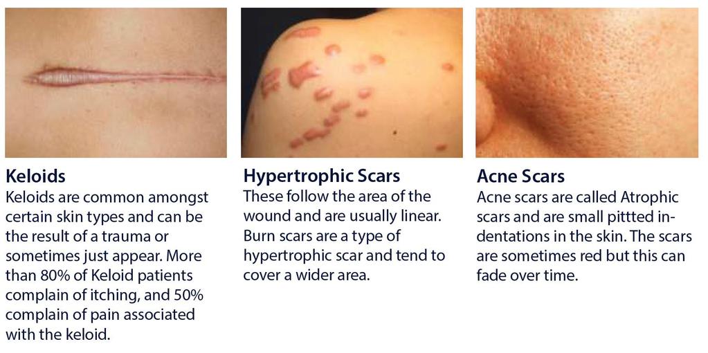 Introduction Clinical Summary Since the introduction of silicone in the early 1980s for the prevention and treatment of hypertrophic & keloid scars, it s therapeutic effects have been well documented