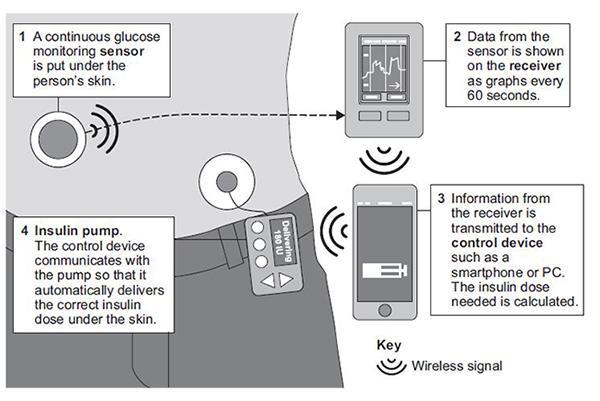 (3) Scientists have developed an artificial pancreas to treat type 1 diabetes. The diagram below shows how an artificial pancreas works. (i) A woman with type 1 diabetes has an artificial pancreas.