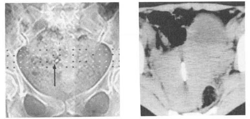 1). In 3 ptients IUDs were in the smll pelvis outside the uterus, in one of them (Fig. 2) the ldder wll lso seemed to e prtly perforted t CT ut the device ws emedded in omentl tissue t lproscopy.