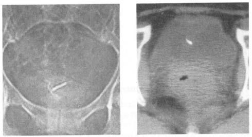 The IUD ws seen close to the nterior dominl wll in 3 of the 7 ptients (Fig. 3). In 6 ptients the IUD ws locted in ftty tissue.