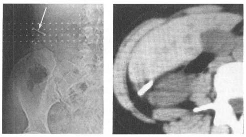 CT scnogrm with IUD situted in the right domen t the level of the umilicus () nd CT () the device etween the liver nd the kidney. Fig. 5. Second CT exmintion.