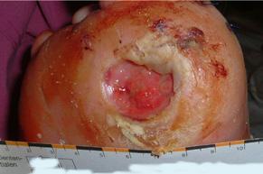 periwound skin (i.e. the skin within 4cm of the wound edge as well as any skin under the dressing) are common and may delay healing, cause pain and discomfort, enlarge the wound, and adversely affect