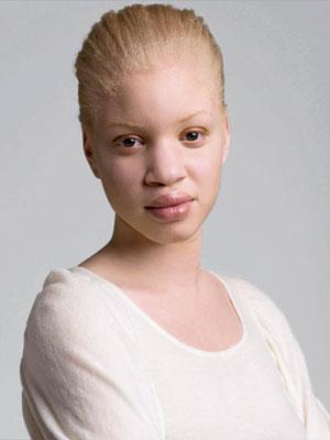 Albinism lack of product, pigment of skin and
