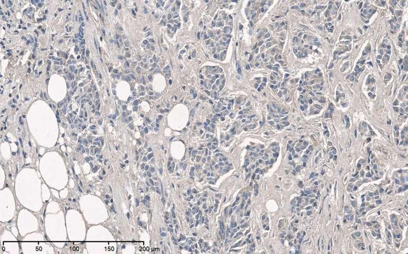 PAI-1 protein expression in ductal invasive breast cancer (mouse monoclonal antibody directed to PAI-1, Ventana