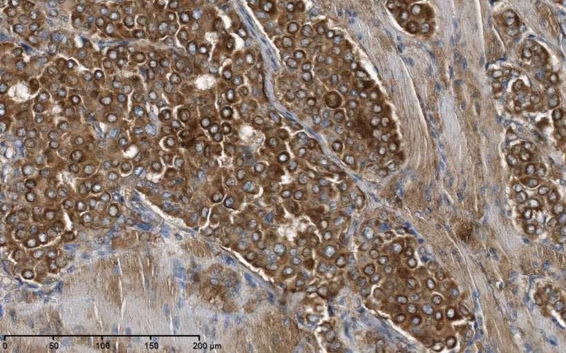 upa protein expression in ductal invasive breast cancer (mouse monoclonal antibody directed to upa, Ventana
