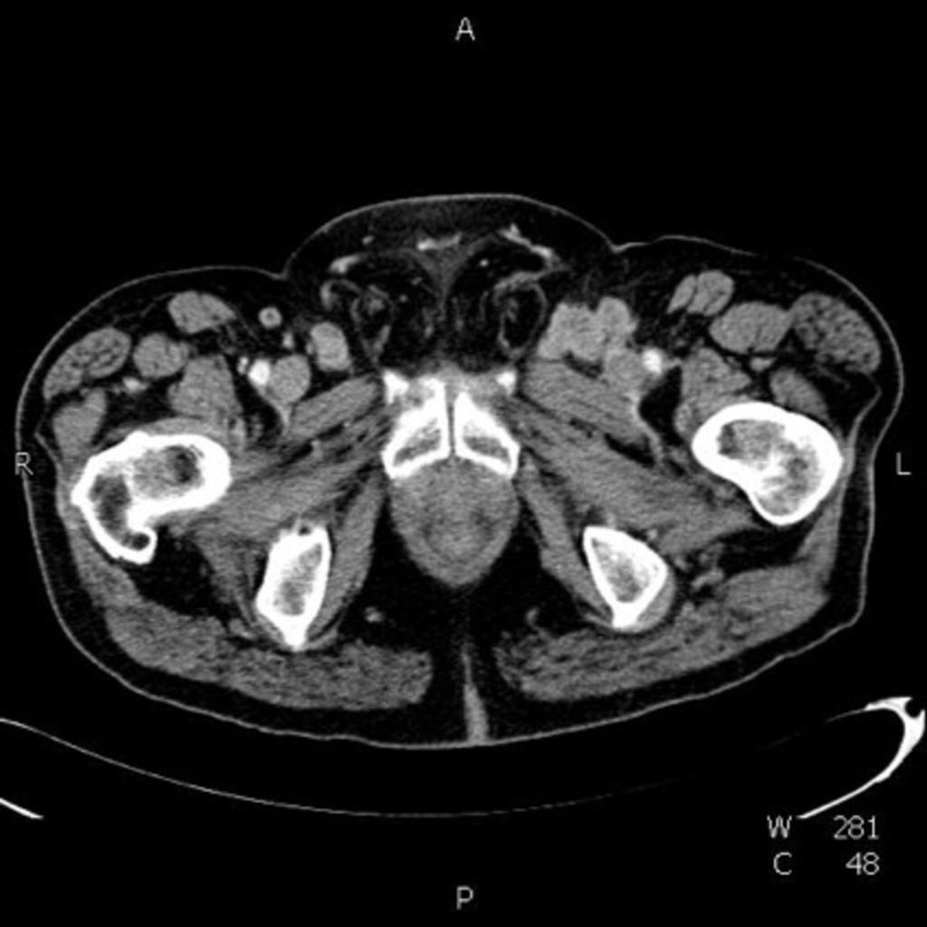 Fig. 4: Squamous penis cancer.