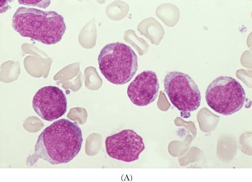 6 M. Greaves and D. Pinkel Fig. 2. Leukaemic (ALL) (A) versus normal blood (B). Courtesy of Dr B Bain. (A) The nucleus of the leukaemic cells is stained red by special dyes.