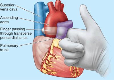 Pericardial sinuses There are two pericardial sinuses: Transverse sinus and oblique