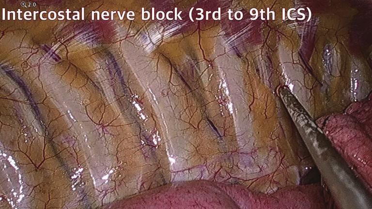 (A) Right vagus nerve block to right paratracheal area; (B) left vagus nerve block to left subaortic area.