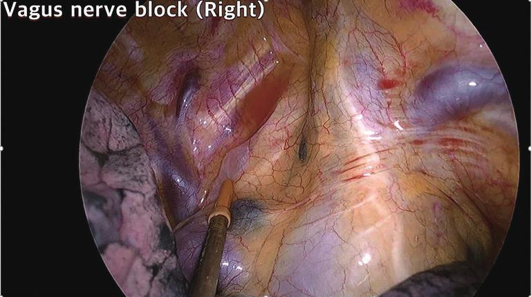 When performing anatomical resection, local anesthesia was also applied to the right paratracheal area or left subaortic area where the vagus nerve passes (Figure 2).