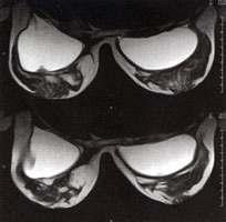 磁力共振 MRI 癌症範圍 手術後跟進 scar