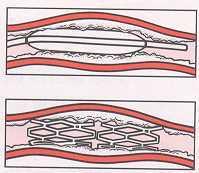 Angioplasty Before Noncardiac Surgery Does not seem to