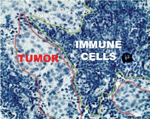 the same tumor block shows the degree of immune infiltration of various cellular