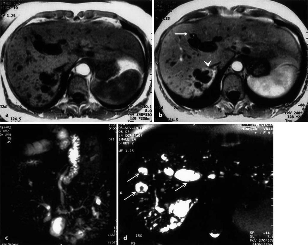 2732 Fig. 1a d Pure form of Caroli s disease involving the entire liver in a 65-year-old woman. a Unenhanced T1-weighted gradientecho image.