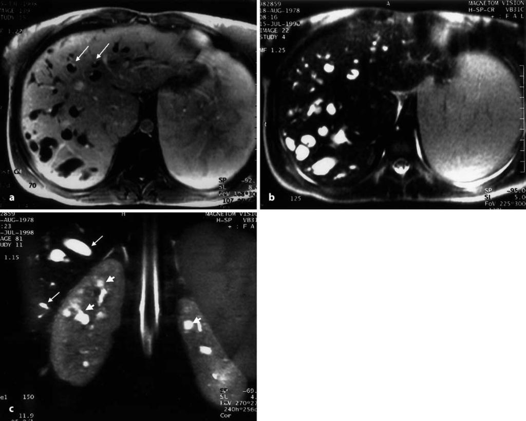 2733 Fig. 2a c Congenital hepatic fibrosis and autosomal-recessive polycystic kidney disease (ARPKD) in a 22-year-old woman.