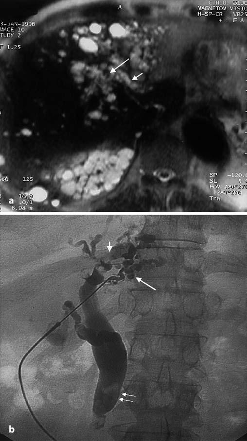 b Percutaneous transhepatic cholangiogram displaying similar findings Although US and CT are widely used to investigate patients with symptoms suggesting biliary disease, direct cholangiography is