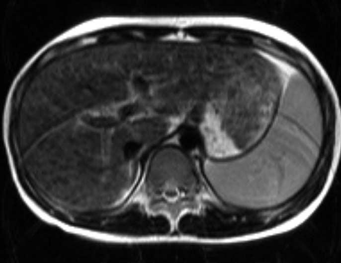 Cheon et al. tent with cirrhosis have been reported in the literature (12-14). However, the clinical applications of MR imaging features of the liver in Wilson s disease have not yet been established.