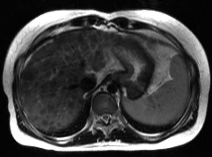 findings and clinical manifestations and severity of hepatic dysfunction.