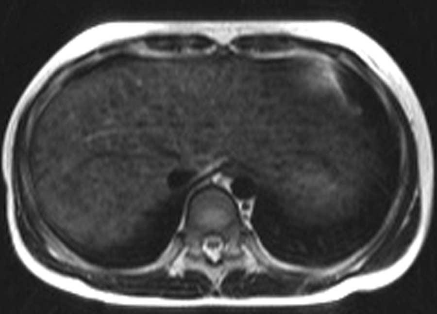 Wilson s Disease and Clinical MR Imaging Application MR Imaging Analysis Two radiologists, each with more than seven years of experience in MR body imaging, retrospectively evaluated the MR images.