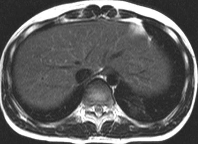 The two readers evaluated the MR images for (a) the presence and pattern of intrahepatic nodules, (b) the contour abnormalities of the liver and (c) additional findings such as a gallbladder