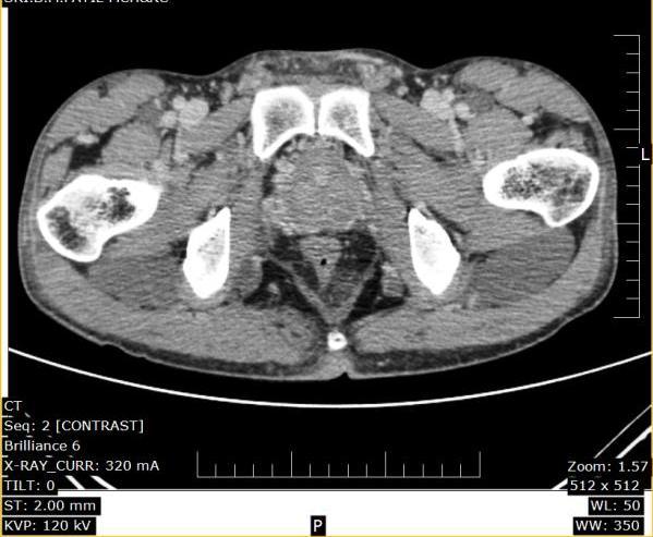 Fig 6: Contrast-CT of pelvis showing enlarged prostate with heterogenous enhancing areas Fig 4: MRI of the abdomen & pelvis showing extensive plexiform neurofibromas involving bilateral paraspinal