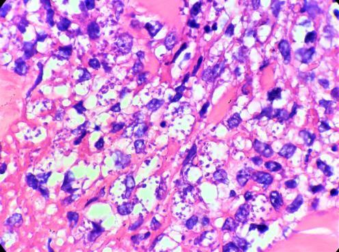 Figure 3. Histopathology of the biopsy specimen: () Round to oval basophilic structures are present in the cytoplasm of macrophages (H&E, x100) which are better highlighted by () Giemsa stain, x100.