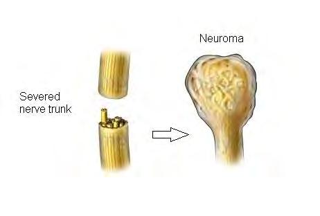 peripheral nerves Neuroma Can
