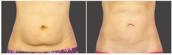 CoolSculpting is the treatment doctors use most for non-invasive fat removal.