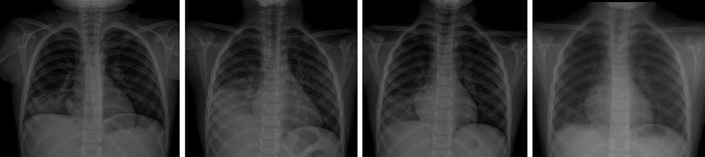 Ho Young Song, et al:oral Prednisolone Therapy for Refractory Mycoplasma pneumoniae Pneumonia in Children A B C D Fig. 3. Chest radiographs of patient 6.