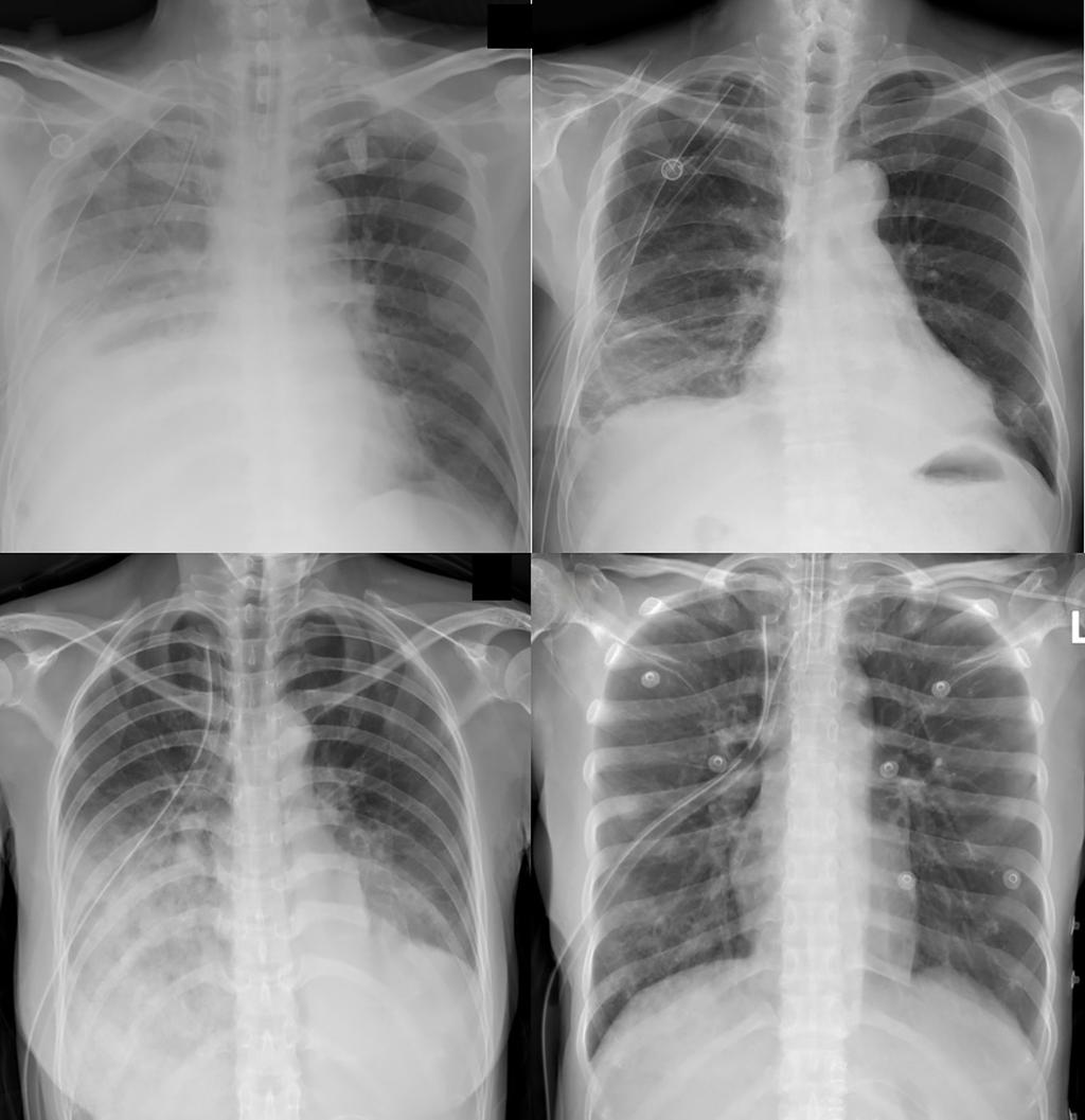 Annals of Translational Medicine, Vol 7, No 5 March 2019 Page 5 of 6 A B C D Figure 3 Chest X-ray of re-expansion pulmonary edema (REPE) just after tube insertion showed diffusely spread infiltrates