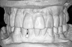 Fixed and removable implant supported prostheses for completely or partially edentulous patients, indications, advantages