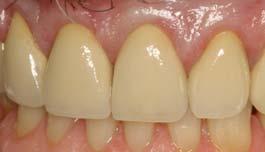Case Study: Single Anterior Tooth Replacement Figure 1a.