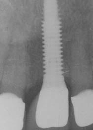 remaining dentition. Figure 1e.