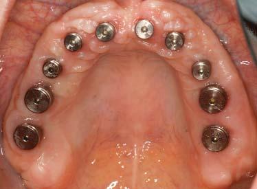 The implants were restored with a CAD/CAM milled screw-retained zirconia bridge.