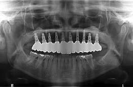 Case Study: Complete Maxillary and Mandibular Tooth Replacement with Fixed