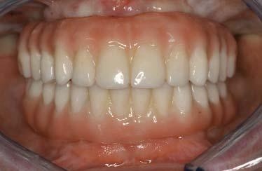 implant placements, which supported immediate, fixed, full-arch, screw-retained,